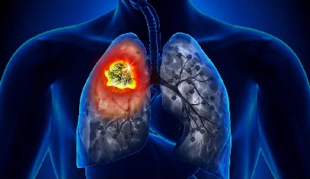 lungcancer